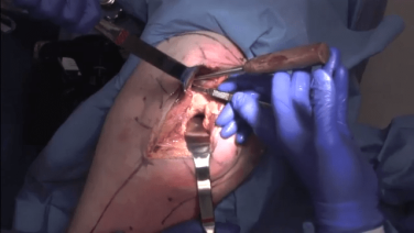 An image of the "Primary Posterior Approach: Incision & Exposure with James Germano, MD" video on the JnJInstitute.com website.