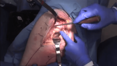 An image of the "Primary Posterior Approach: Capsule & Dislocation with James Germano, MD" video on the JnJInstitute.com website.