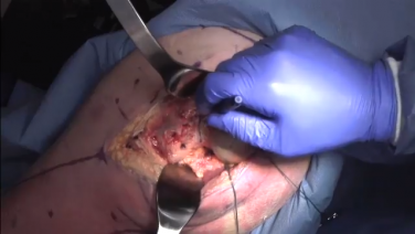 An image of the "Primary Posterior Approach: Osteotomy & Acetabular Exposure with James Germano, MD" video on the JnJInstitute.com website.