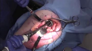 An image from the "Primary Posterior Approach: Acetabular Reaming & Implantation with James Germano, MD" video on the JnJInstitute.com website.