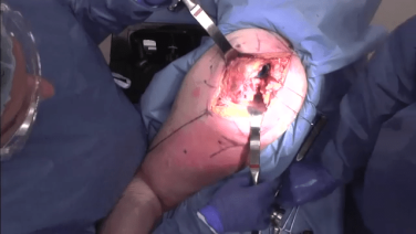 An image of the "Primary Posterior Approach: Femoral Preparation with James Germano, MD" video on the JnJInstitute.com website.