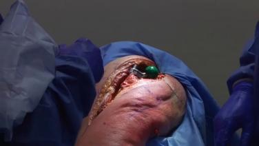 An image of the "RECLAIM® Revision Hip System via Posterior ETO - RECLAIM Proximal Body with James Germano, MD" video on the JnJInstitute.com website.