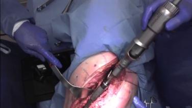 An image from the "RECLAIM® Revision Hip System via Posterior ETO - RECLAIM Assembly with James Germano, MD" video on the JnJInstitute.com website.