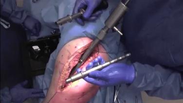 An image of the "RECLAIM® Revision Hip System via Posterior ETO - RECLAIM Disassembly with James Germano, MD" video on the JnJInstitute.com website.