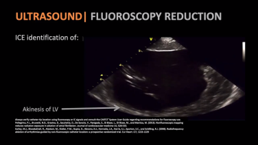 An image for the "Ischemic VT - Procedural Tools & Approaches with Andrew Brenyo, MD, FHRS" video on the JnJInstitute.com website.
