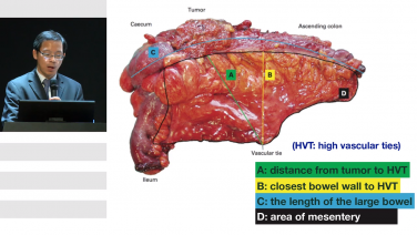 D3 Dissection in Laparoscopic Right Hemicolectomy with Hung-Chang Chen, MD