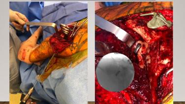 An image from the "NITINOL Continuous Compression Implants with Kevin Grant, MD" video on the JnJInstitute.com website.