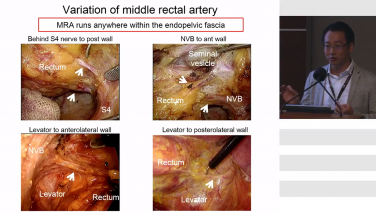 Lateral Node Dissection Techniques with Tsuyoshi Konishi, MD