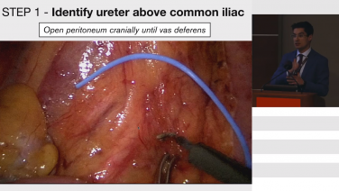 Lateral Node Dissection Steps with Guilherme Pagin São Julião, MD
