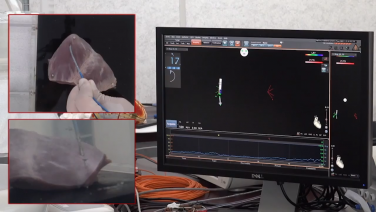 Biophysics of RF Ablation with Laurent Macle, MD, Part 3 of 5: Point by Point vs Drag Lesion Sets