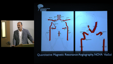 An image of the "The Role of Embolization in Treatment of AVM - Ali Alaraj, MD" video.