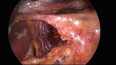 An Image From "Lipham - LINX Full Unedited Procedure"