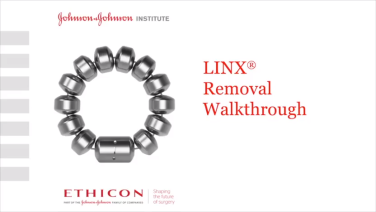 LINX® Reflux Management System - Device Removal Walkthrough