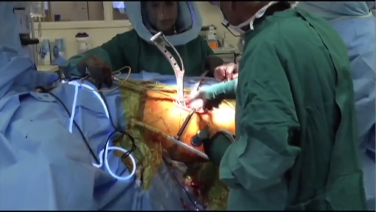 ANTERIOR ADVANTAGE™ Broaching Tips with the CORAIL® Hip Stem by Joel Matta, MD & Tania Ferguson, MD