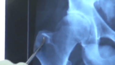 Changing the Acetabulum Radius of Curvature in a Dysplastic Hip with Joel Matta, MD thumbnail