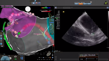 An image from the "Experience with the CARTO VIZIGO™ Sheath with Bret Gidney, MD" video on the JnJInstitute.com website.
