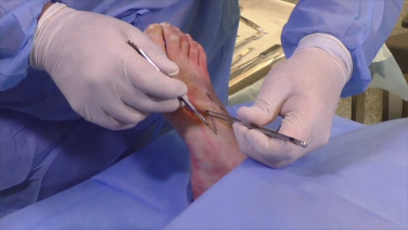 An image from the "Lisfranc Injuries - Procedural Demonstration Alan Ng, DPM, FACFAS" video on the JnJInstitute.com website.