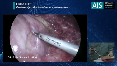 An image from the "Revision Bariatric Surgery - Gastro-Jejunal Sleeve / Redo Gastro-Entero Procedure with Almino Ramos, MD" video on JnJInstitute.com website.