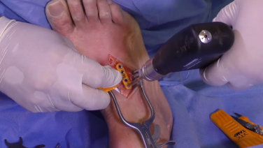 An image from the "Lisfranc Arthrodesis: Using Autogenous Bone Graft & the Trephine Technique with Alan Ng, DPM, FACFAS" video on the JnJInstitute.com website.