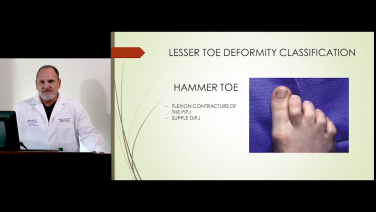 An image from the "Surgery of the Lesser Toe Deformity - Types, Etiology, Workup & Live Patient Exam with Brian G. Loder, DPM" video on the JnJInstitute.com website.