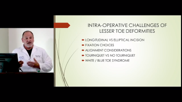 An image from the "Surgery of the Lesser Toe Deformity - Surgical Correction with Brian G. Loder, DPM" video on the JnJInstitute.com website.