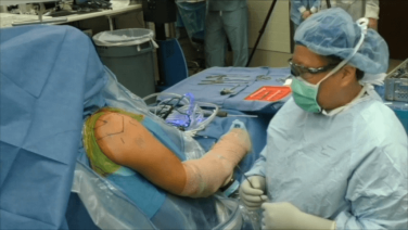 Acute Full Thickness Rotator Cuff Tear - Surgical Demonstration - Stephanie Muh, MD thumbnail