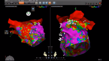 An image from the "Demystifying Complex Tachycardias with Ripple Mapping with Daniel Melby, MD" video playlist on the JnJInstitute.com website.