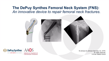 An image from the "Femoral Neck System (FNS) - An Innovative Device to Repair Femoral Neck Fractures" video on the JnJInstitute.com website.