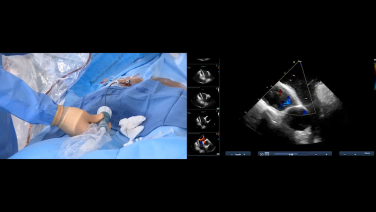 A image of atrial septal defect intervention procedure aside the echocardiography screen as shown on the jnjinstitute.com website.