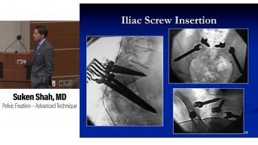 An image from the "Neuromuscular Scoliosis: Pelvic Fixation – A Master’s Technique with Suken Shah, MD" video on the JnJInstitute.com website.