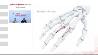 An image from the "Introduction to Variable Angle Hand Locking System with Douglas Campbell, MD" video on the JnJInstitute.com website.