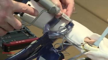 An image from the "Variable Angle Locking Plate for Thumb Fractures - The Palmer Approach with Douglas Campbell, MD" video on the JnJInstitute.com website.