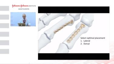 An image from the "The Phalangeal Base Plate with Douglas Campbell, MD" video on the JnJInstitute.com website.