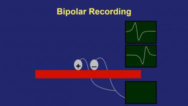An image from the "Bipolar Electrograms Recording with Joshua Cooper, MD" video on the JnJInstitute.com website.