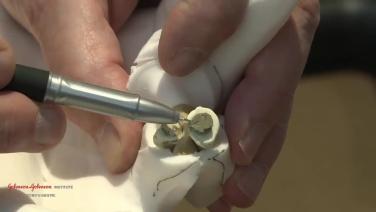 An image from the "Articular Osteotomy Lab Demonstration with Douglas Campbell, MD" video on the JnJInstitute.com website.
