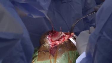 An image from the "Cementing Best Practices Featuring the ATTUNE® Knee System - Surgeon Discussion & Live Surgery" video on the JnJInstitute.com website.