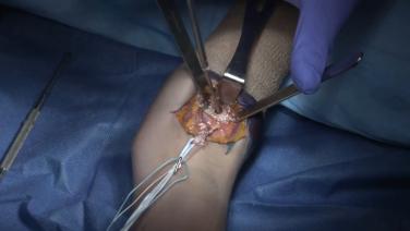 An image from the "Distal Biceps Repair Marc Labbe, MD" video on the JnJInstitute.com website.