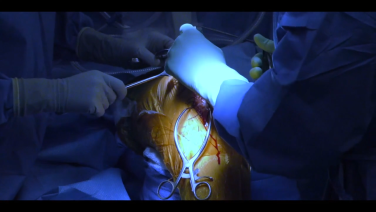 An image from the "Total Knee Arthroplasty using the ATTUNE® Knee System: Initial Approach & Dissection with William Barrett, MD" video on the JnJInstitute.com website.