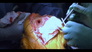 An image from the "Total Knee Arthroplasty using the ATTUNE® Knee System: Patella Preparation with Cutting Guide with William Barrett, MD & Jana Flener, PA-C " video on the JnJInstitute.com website.