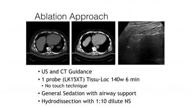 An image from the "CT Ablation - No Touch Technique with David Liu, MD" video on the JnJInstitute.com website.