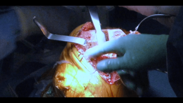 Removal of Medial Lateral Meniscus and PCL - William Barrett, MD thumbnail