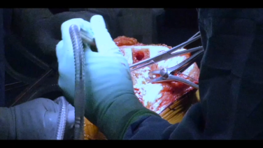 An image from the "Total Knee Arthoplasty Using the ATTUNE® Knee System - Removal of Medial Lateral Meniscus & PCL with William Barrett, MD & Jana Flener, PA-C" video on the JnJInstitute.com website.