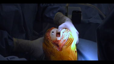 image of "Total Knee Arthroplasty using the ATTUNE® Knee System: Fine-Tuning the Flexion Extension Gap with William Barrett, MD & Jana Flener, PA-C" video on jnjinstitute.com