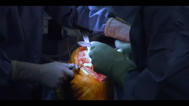 Left Total Knee Arthroplasty using the ATTUNE Knee System: Tibial Surface Preparation & Implant Placement with William Barrett, MD thumbnail