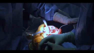 An image from the "Left Total Knee Arthroplasty using the ATTUNE® Knee System: Tibial Surface Preparation & Implant Placement" video on the JnJInstitute.com website.