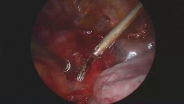 An image from the "Ultrasonic Energy in VATS with Moishe Liberman, MD" playlist on the JnJInstitute.com website.