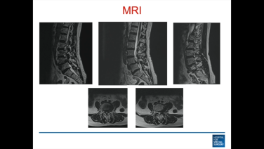 An image from the "Pushing the Boundaries of Minimally Invasive Spine Surgery: Case Presentation with Andrew Sama, MD" video on the JnJInstitute.com website.