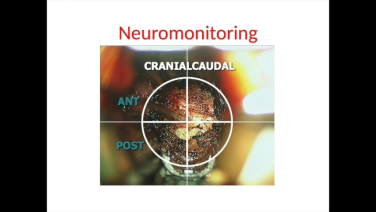 An image from the "Neuromonitoring in Lumbar Spine with Jeffrey Roh, MD" video on the JnJInstitute.com website.