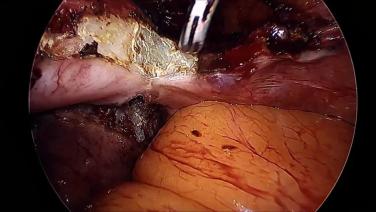 An Image From "Dr. McCarus - TLH Adhesiolysis HDi SFX SPDR"