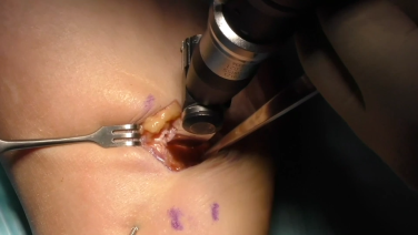 An image from the "Flatfoot Reconstruction: Evans Calcaneal Osteotomy Surgical Technique Demonstration with Alan Ng, DPM" video on the JnJInstitute.com website.